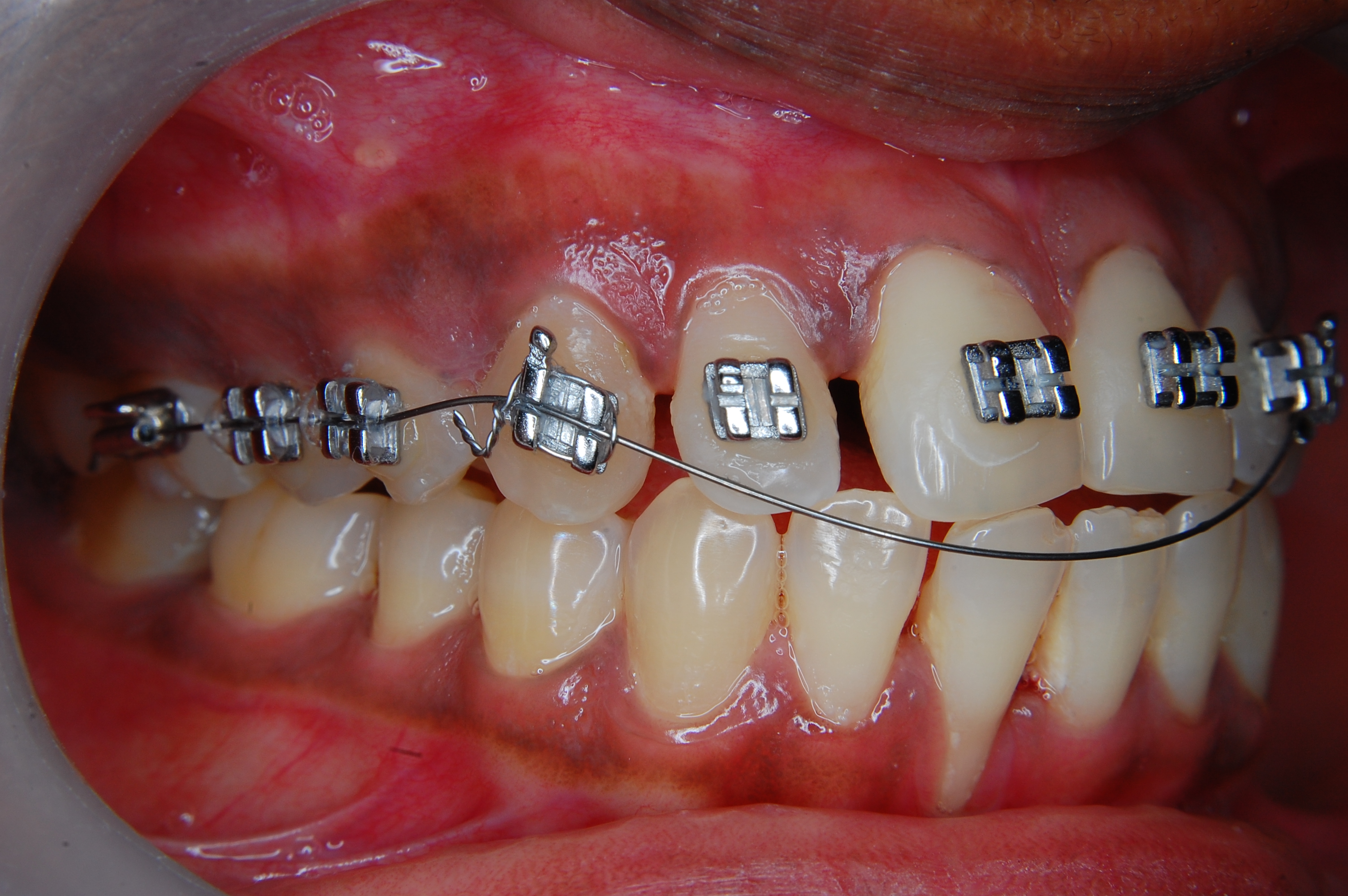 Common Complications of Orthodontic Treatment